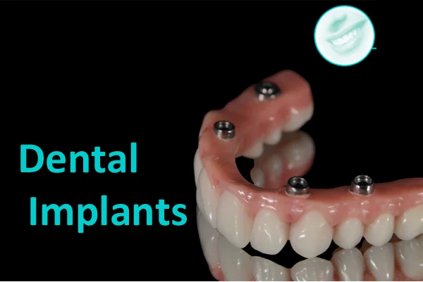 Dental Implants