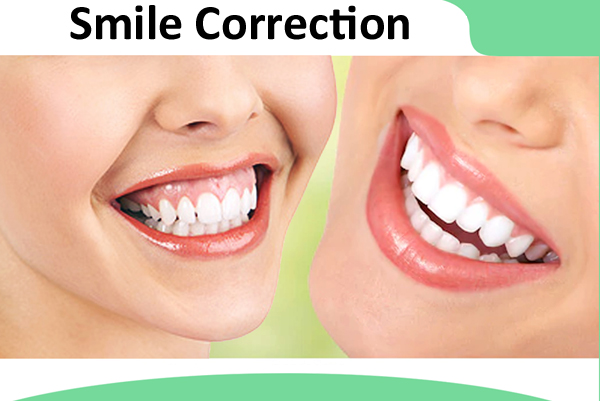 Smile Correction