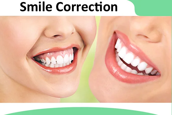 Smile Correction