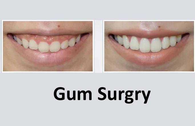 Gum Surgery